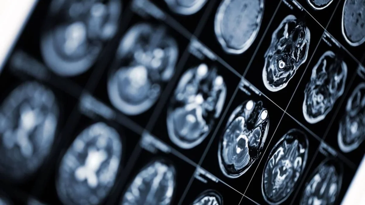 Convocan a voluntarixs para un estudio que busca la cura del Alzheimer