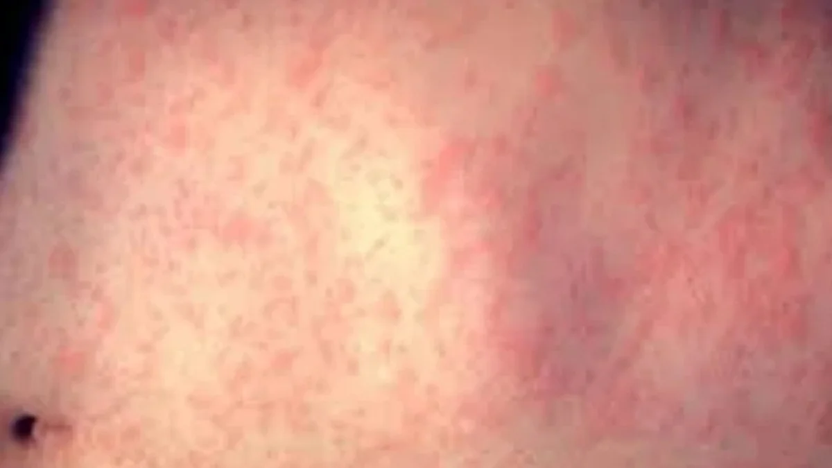 Paraguay: confirman un caso de sarampión tras 10 años sin circulación del virus