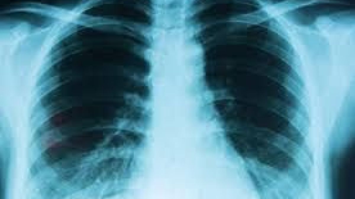 Cáncer de pulmón: alertan por aumento de casos en el país