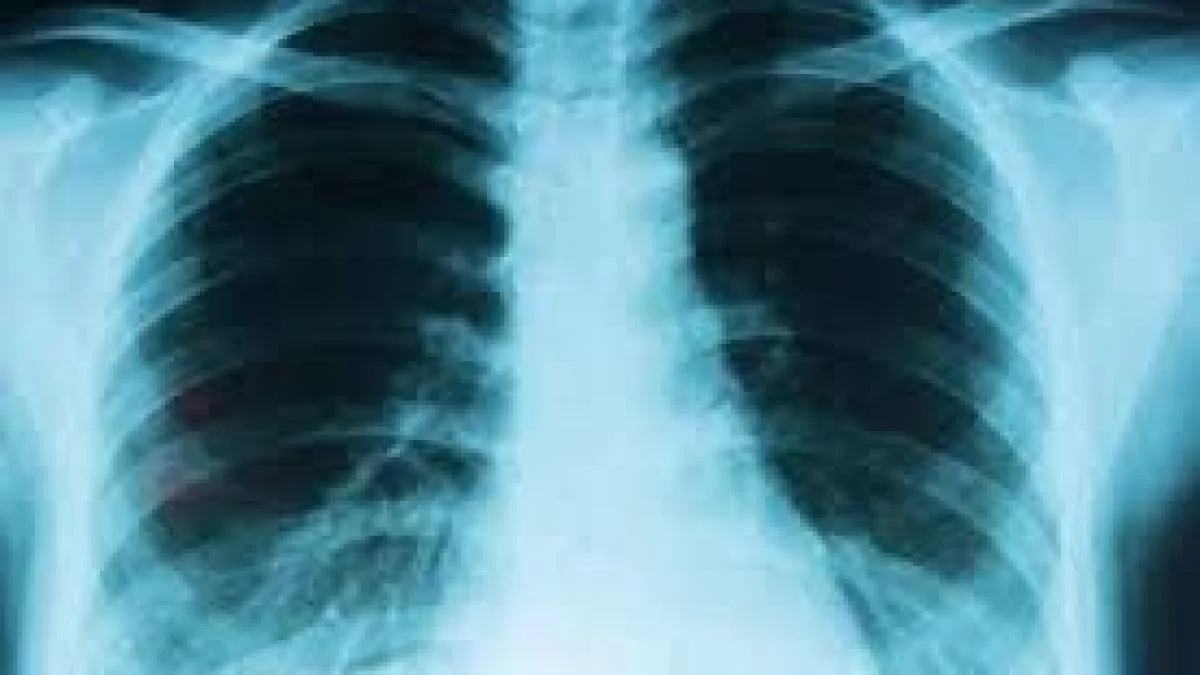 Cáncer de pulmón: alertan por aumento de casos en el país